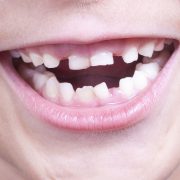 baby_teeth_1280